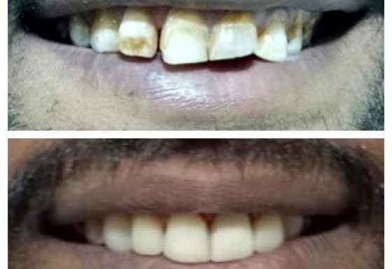 Cosmetic dental Procedures